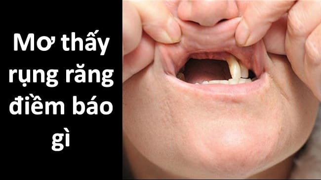 mo thay rung rang